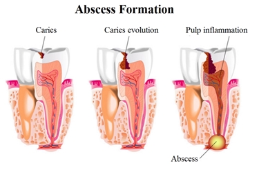Lo sviluppo della carie e l'ascesso