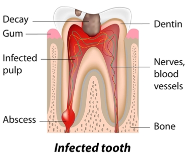 Sezione di un dente malato