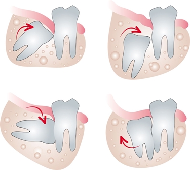 Problemi ai denti del giudizio