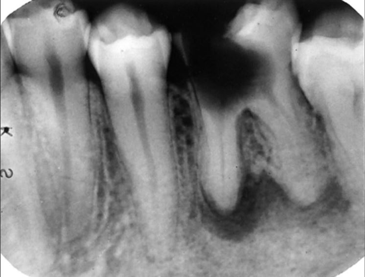 Granuloma dentale