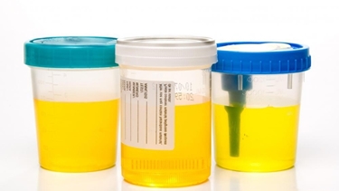 Raccolta delle urine per esame