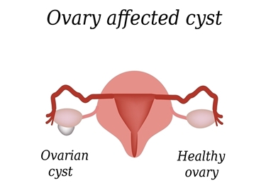 Ciste esterna all'ovaia