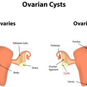Confronto ovaio con e senza cisti