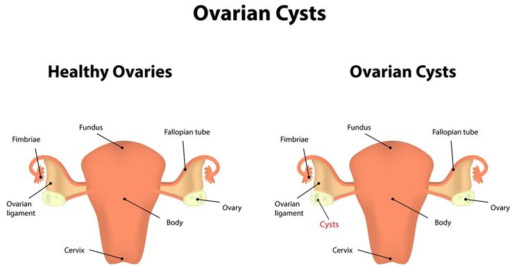 Confronto ovaio con e senza cisti