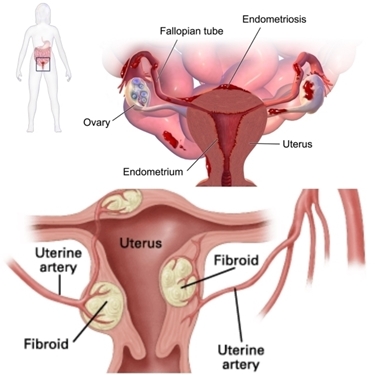 endometriosi