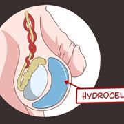 Rappresentazione grafica dell'idrocele