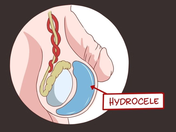 Rappresentazione grafica dell'idrocele