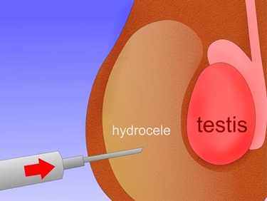 Aspirazione del liquido dell'idrocele