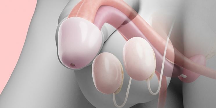 Formazione nodulo testicolare