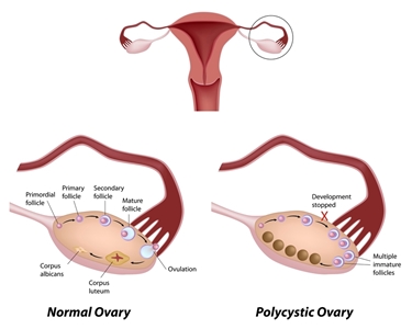 Ovaio normale e policistico