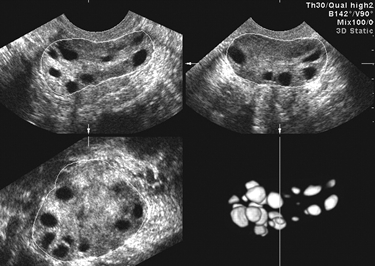 Ecografia di ovaio policistico