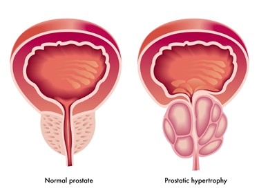 prostata<p />