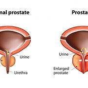 Prostatite in atto