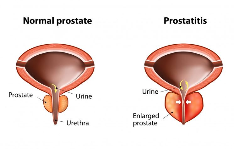 Prostatite in atto