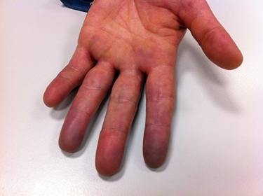 sindrome di raynaud