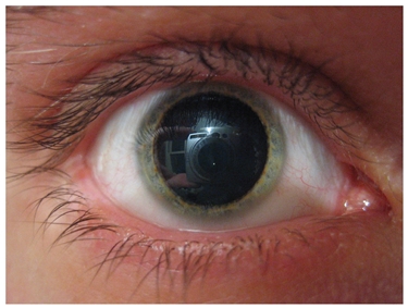 Pupilla dilatata dall'atropina