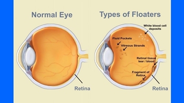 Occhio normale e occhio con miodesopsia<p />