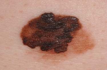 melanoma