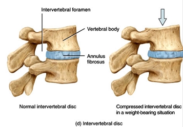 La posizione del disco intervertebrale