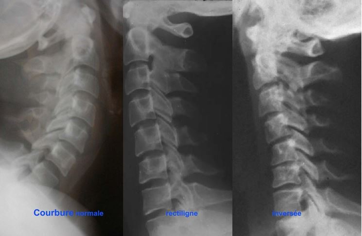 Esempi di lordosi cervicale