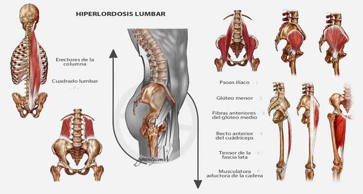 Iperlordosi lombare muscoli interessati