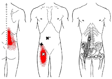 Terapia fisica per la sciatica