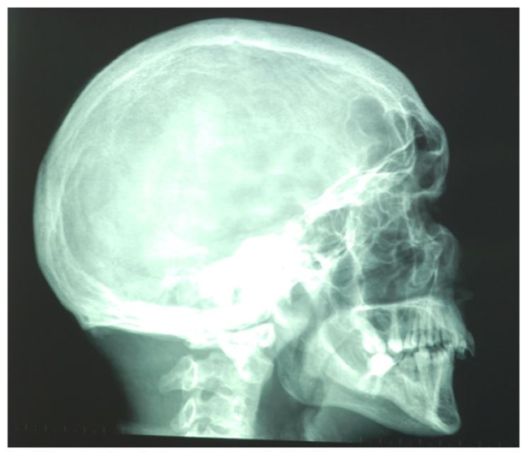 Malformazione fossa craniale posteriore