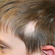 Caso di alopecia congenita