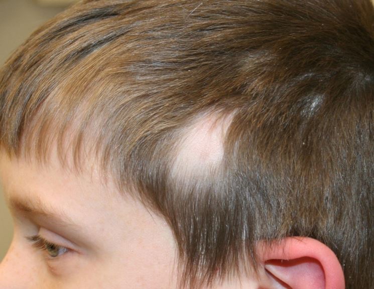 Caso di alopecia congenita