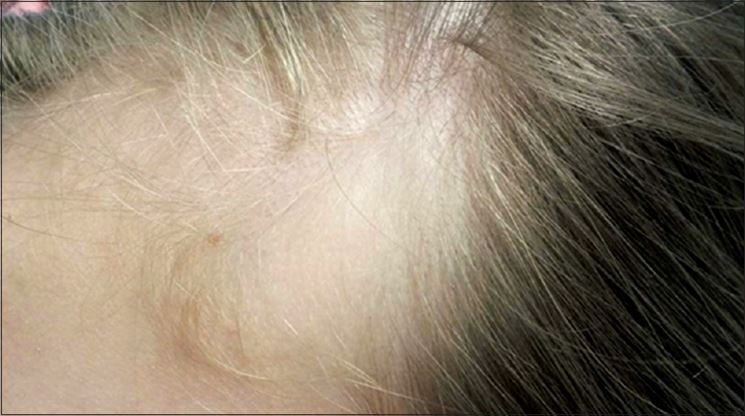 Alopecia congenita triangolare