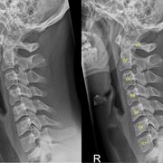 Radiografia del rachide cervicale