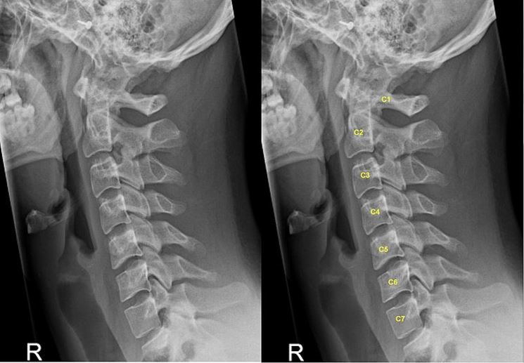 Radiografia del rachide cervicale