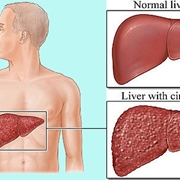 Fegato sano e con Cirrosi