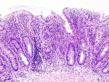 Intestino infiammato al microscopio