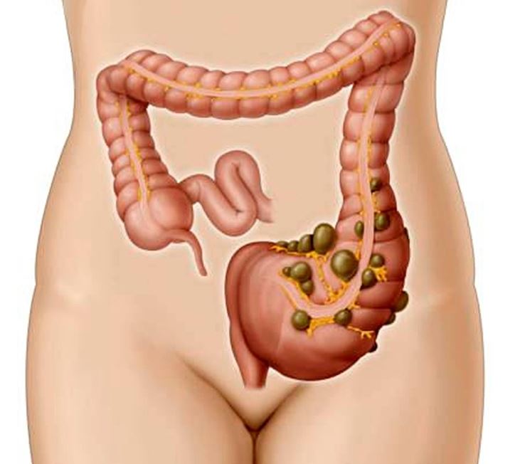 Infiammazione per diverticoli