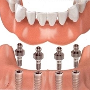 impiantologia dentale 
