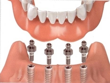 impiantologia dentale 