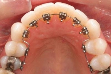 ortodonzia linguale 