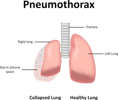 Pneumotorace