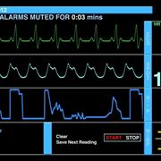 Parametri cardiaci su ecg