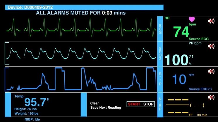 Parametri cardiaci su ecg