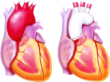 Aneurisma aortico e protesi