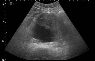 Ecografia di aneurisma dell'aorta