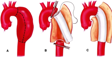 La chirurgia per l'aneurisma dell'aorta