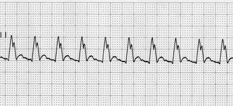 Tracciato elettrocardiografico