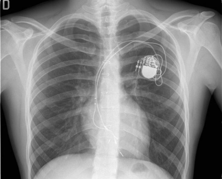 Portatore pacemaker