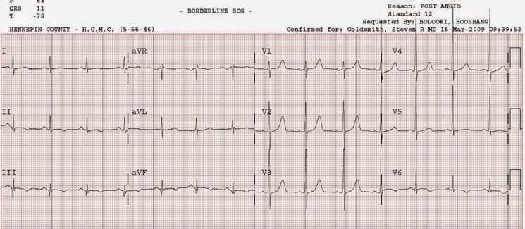 ECG paziente ischemico