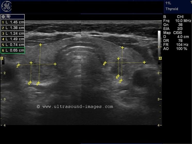 Ecodoppler tiroide