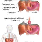 Descrizione dell'ernia iatale
