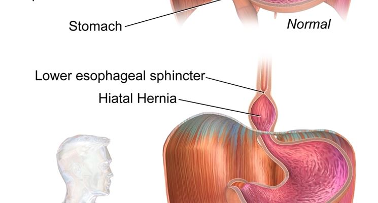 Descrizione dell'ernia iatale